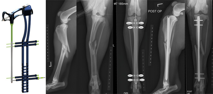 TIbial fracture repair stabilized with a BioMedtrix iLOC interlocking nail via a minimally invasive approach 